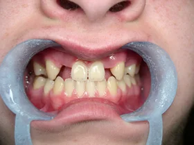 Before: noticeable gaps between the upper front teeth