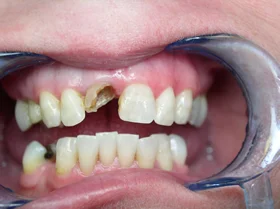 Before: dull, yellowed teeth before professional whitening