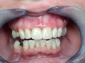 After: noticeably brighter smile following professional whitening with Dr. Scott J. Pettinato, DMD