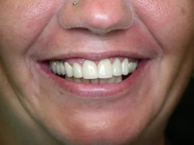 After: chips repaired and shade brightened with cosmetic bonding
