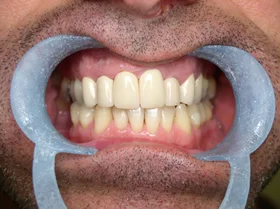After: crowns and tooth replacement restoring a complete, natural smile