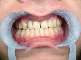 After: gaps closed for an even, natural-looking smile line