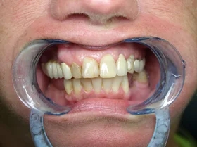 Before: worn and uneven upper front teeth with visible chipping