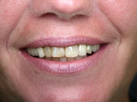Before: chipped and discolored upper front teeth