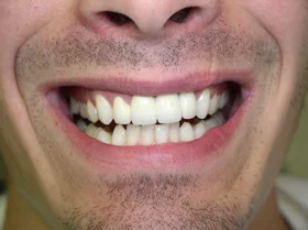 After: porcelain veneers creating a bright, uniform smile in Scranton, PA