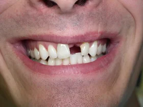 Before: stained teeth with old, discolored restorations
