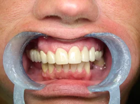 After: evenly shaped, natural-white front teeth restored at Pettinato Dental Care in Scranton, PA