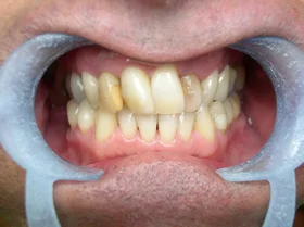 Before: broken and missing teeth affecting the bite and smile